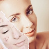 Ilustracija, montaza, prikazana je devojka sa lepim tenom, a u ruci drzi kao masku na kojoj se vidi kako je ranije izgledalo lice sa bubuljicama.