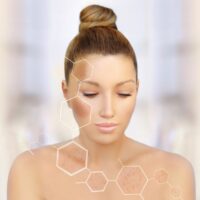 Devojka na čijem se licu i dekolteu vide hiperpigmentacije, odnosno tamne fleke.