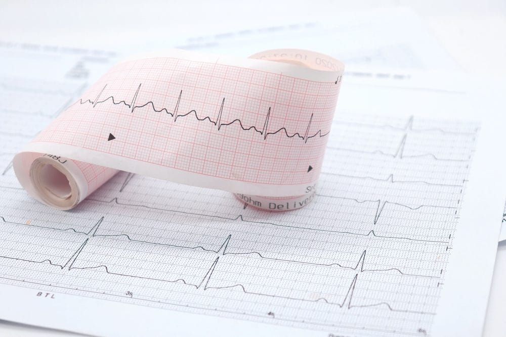 EKG rezultat na odštampanom papiru.