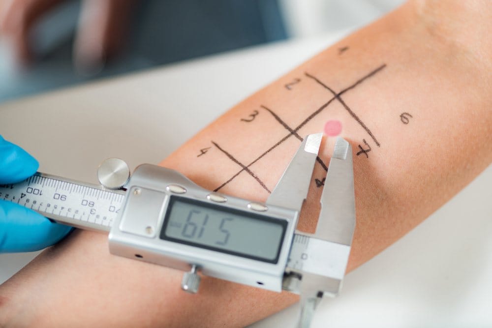 Merenje dijametra reakcije na alergen.