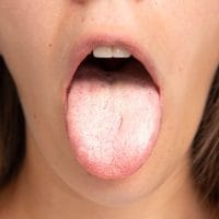 Kandida u uusnoj duplji, bela, kao skrama na jeziku.