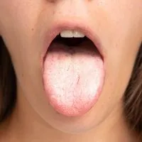 Kandida u uusnoj duplji, bela, kao skrama na jeziku.