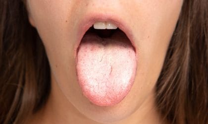 Kandida u uusnoj duplji, bela, kao skrama na jeziku.