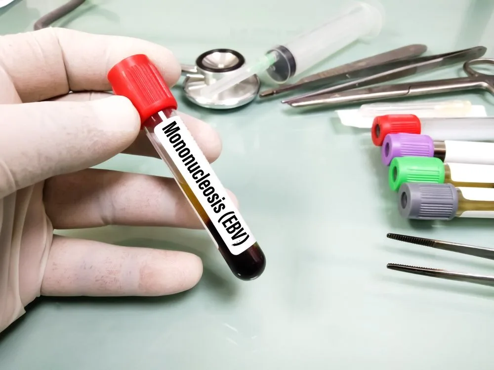 Laboratorija, tehničar drži epruvetu sa uzorkom krvi. Test je za prisustvoepšatajn bar virusa koji izaziva mononukleozu.