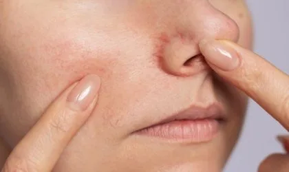 Površinski kapilari na obrazu i oko baze nosa.