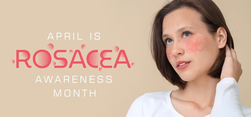 Plakat-devojka na obrazima ima rozaceu.
Pi&scaron;e-April mesec rozacee.