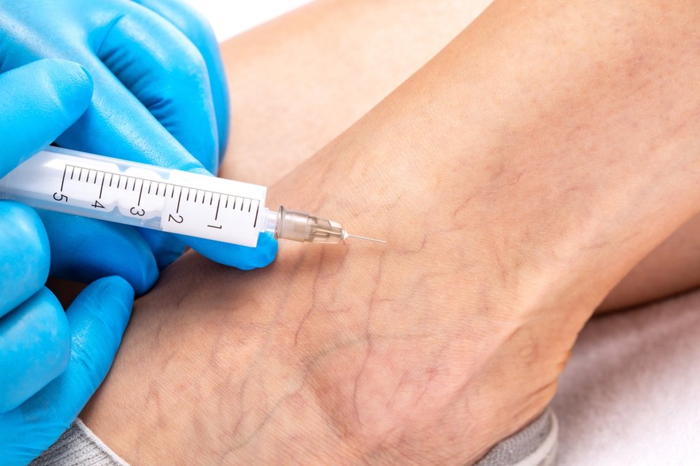 Tretiranje paučinastih vena skleroterapijom. Doktor, nosi plave rukavice. Špricem i iglom ubrizgava tečnost u paučinaste vene.